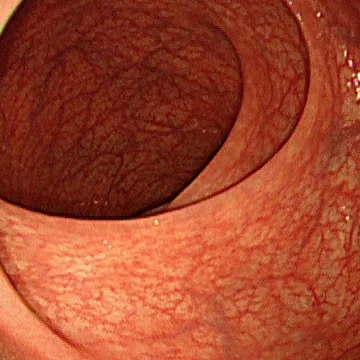Photo of intestinal mucosal recovery after treatment
