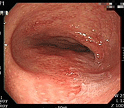 Photo of intestinal mucosa before treatment