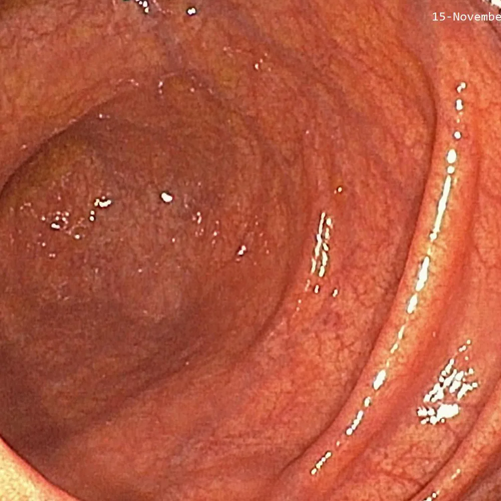 Photo of intestinal mucosal recovery after treatment