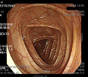 Intestinal mucosal recovery photo after treatment