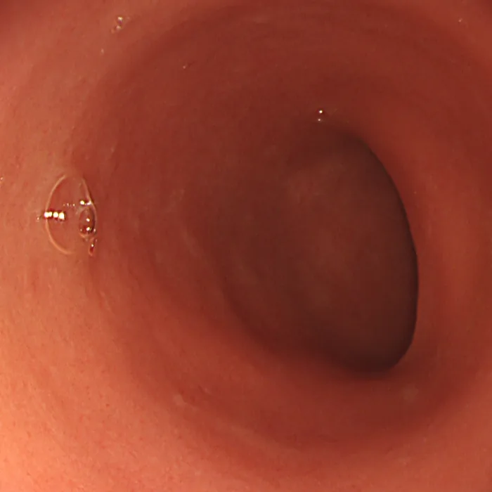 Photo of intestinal mucosal recovery after treatment