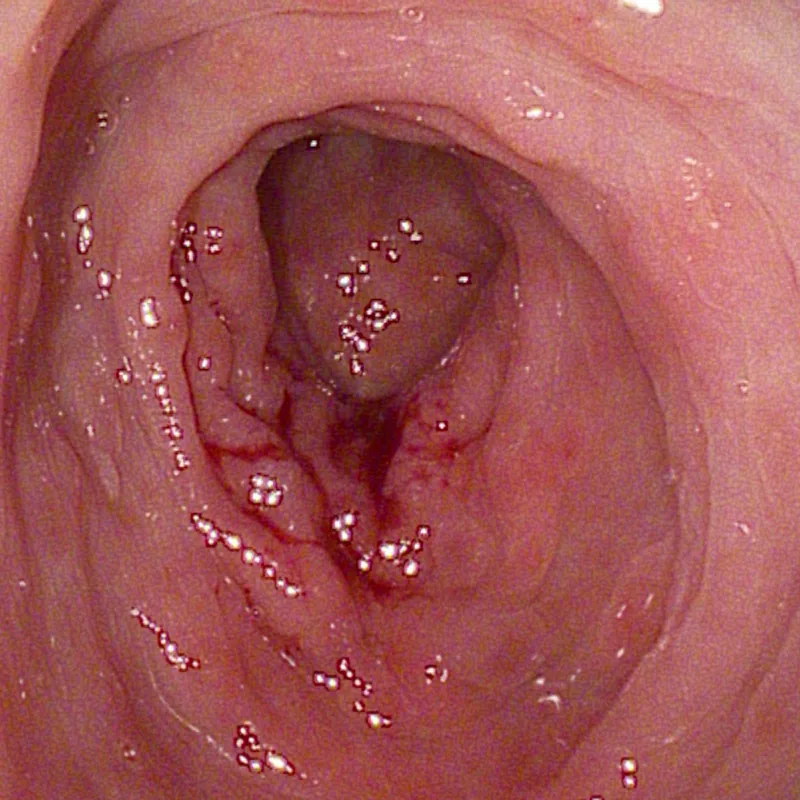 Intestinal mucosal photo before treatment