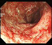 Photo of intestinal mucosa before treatment