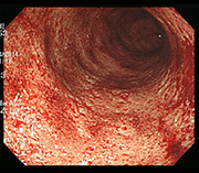 Photo of intestinal mucosa before treatment