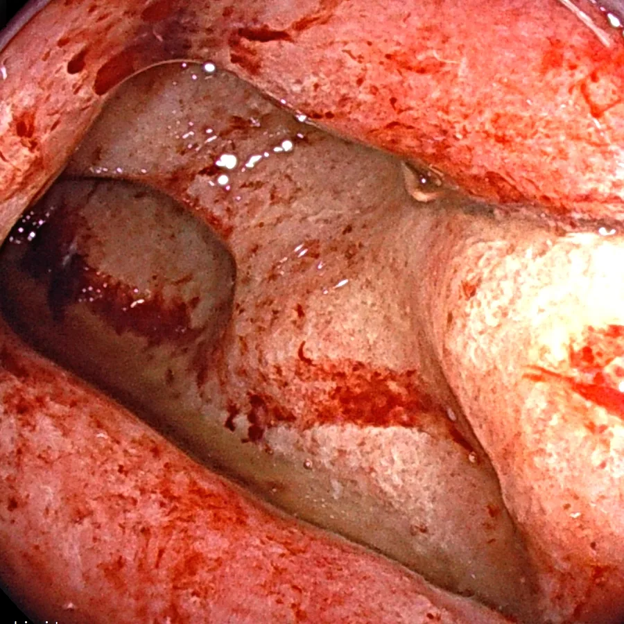Photo of intestinal mucosa before treatment