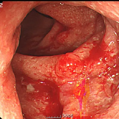 Photo of intestinal mucosa before treatment