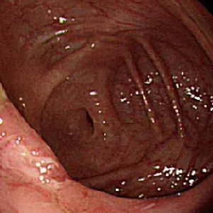 Intestinal mucosal photo before treatment