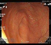 Photo of intestinal mucosal recovery after treatment