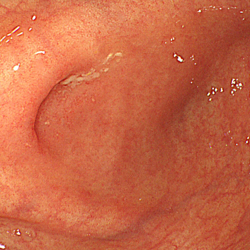 Photo of intestinal mucosal recovery after treatment