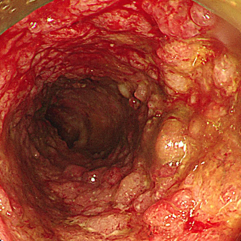 Photo of intestinal mucosa before treatment