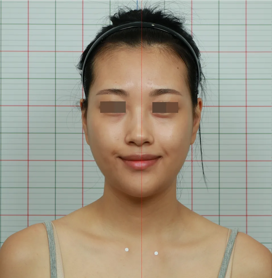 Face Core Fit before treatment 2