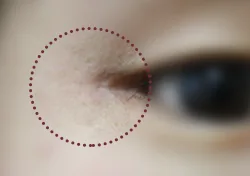 흉터 치료 전