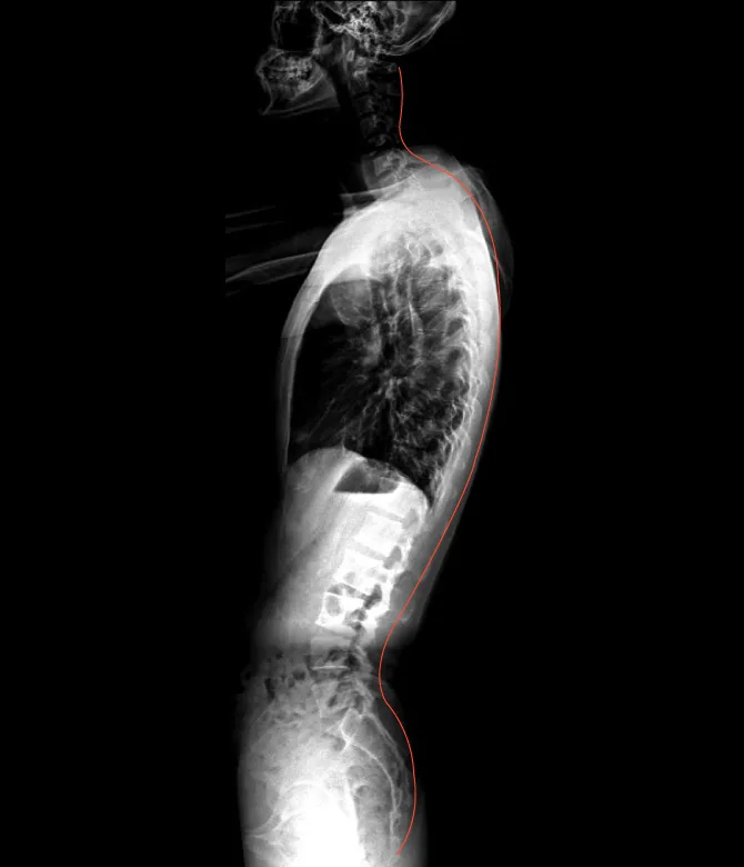 X-ray