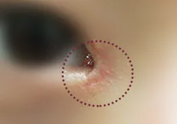 앞트임 흉터 치료 전