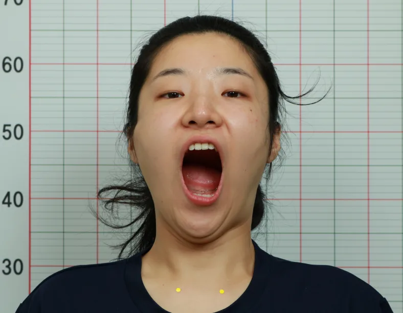 턱관절장애 시술 후 2