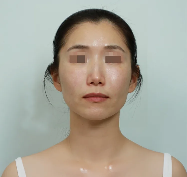 Face Core Fit after treatment 1