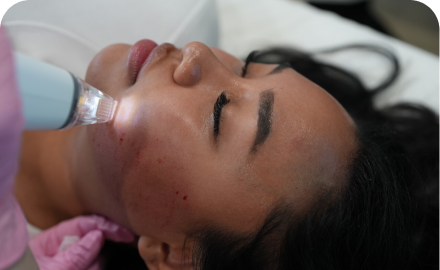 rf microneedling