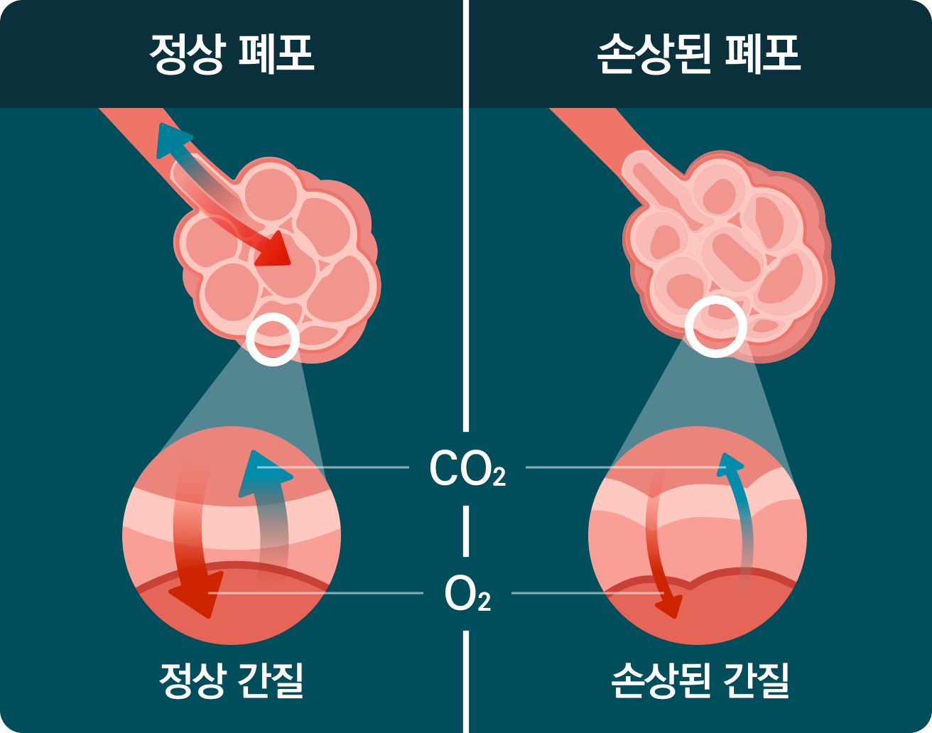 정상 폐포, 손상된 폐포