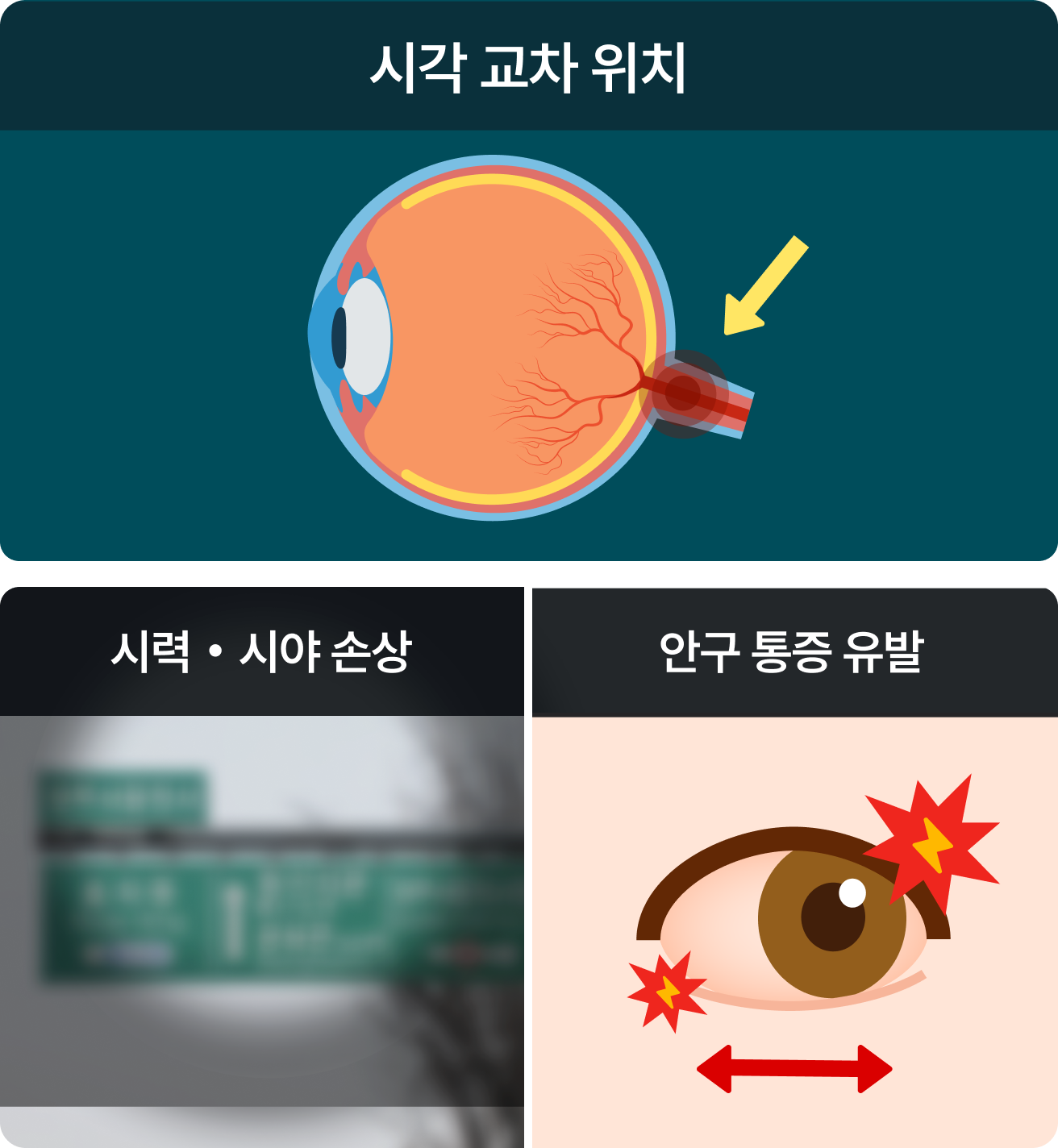 시각 교차 위치, 시력 및 시야 손상, 안구 통증 유발