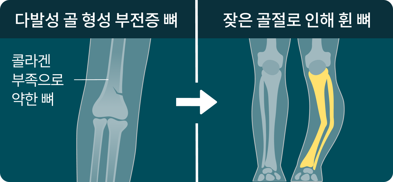 다발성 골 형성 부전증 뼈, 콜라겐 부족으로 약한 뼈, 잦은 골절로 인해 휜 뼈