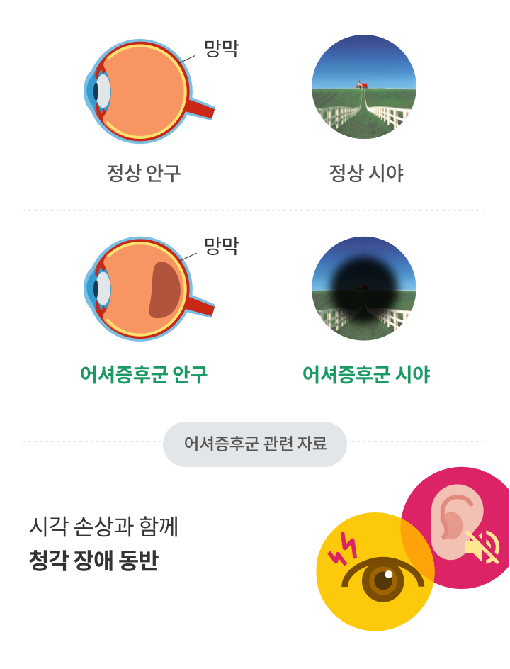 어셔증후군 안구, 어셔증후군 시야, 시각 손상과 함께 청각 장애 동반