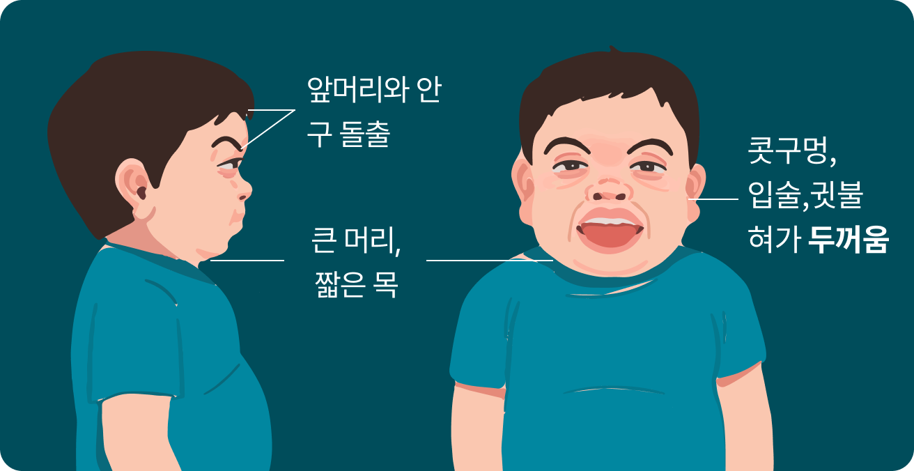 앞머리와 안구 돌출, 큰 머리, 짧은 목, 콧구멍, 입술, 귓불 혀가 두꺼움