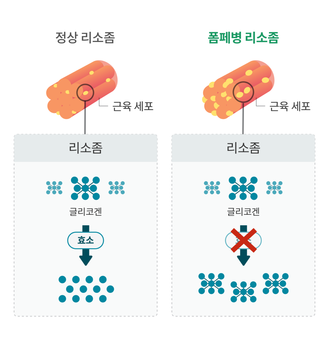 폼페병 리소좀