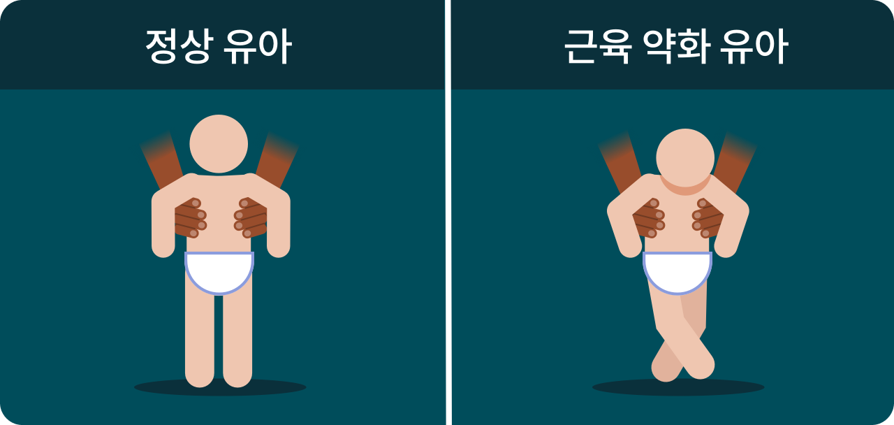 근육 약화 유아