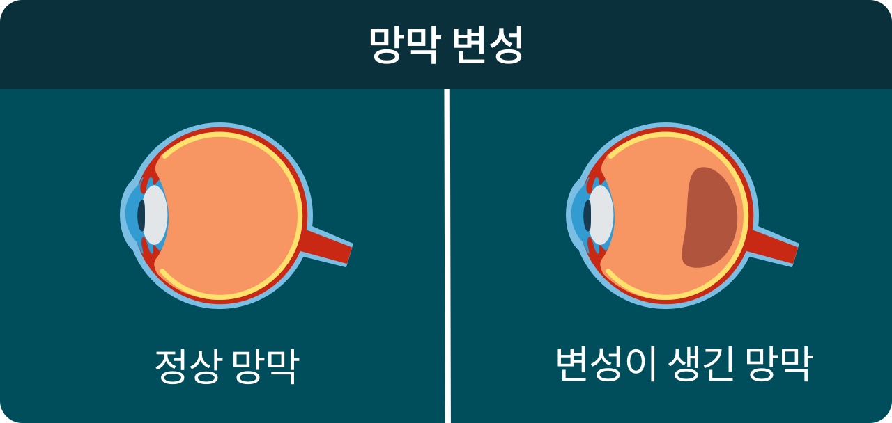 망막 변성