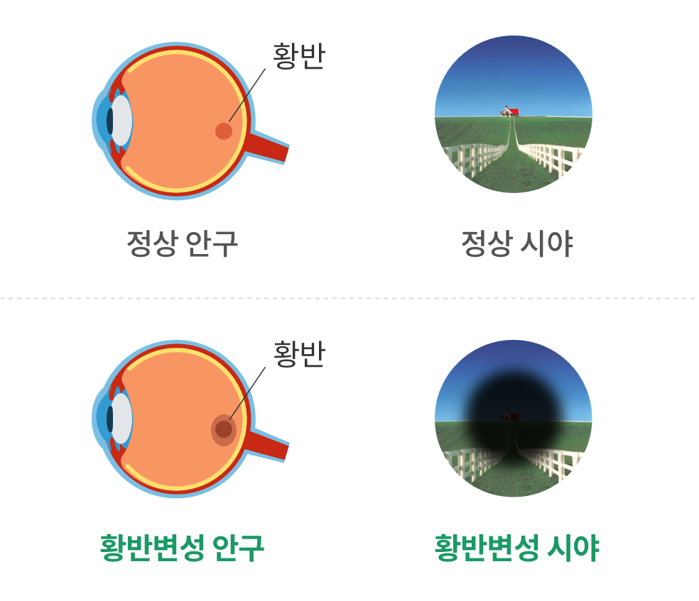 황반변성 안구, 황반변성 시야