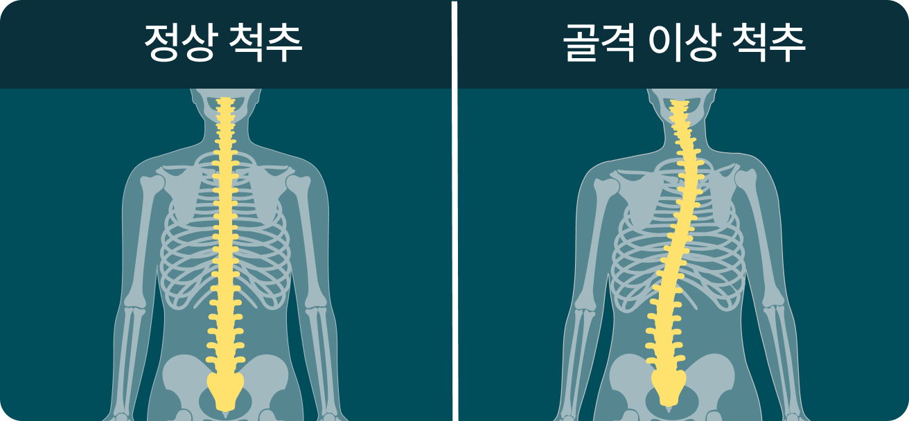 골격 이상 척추