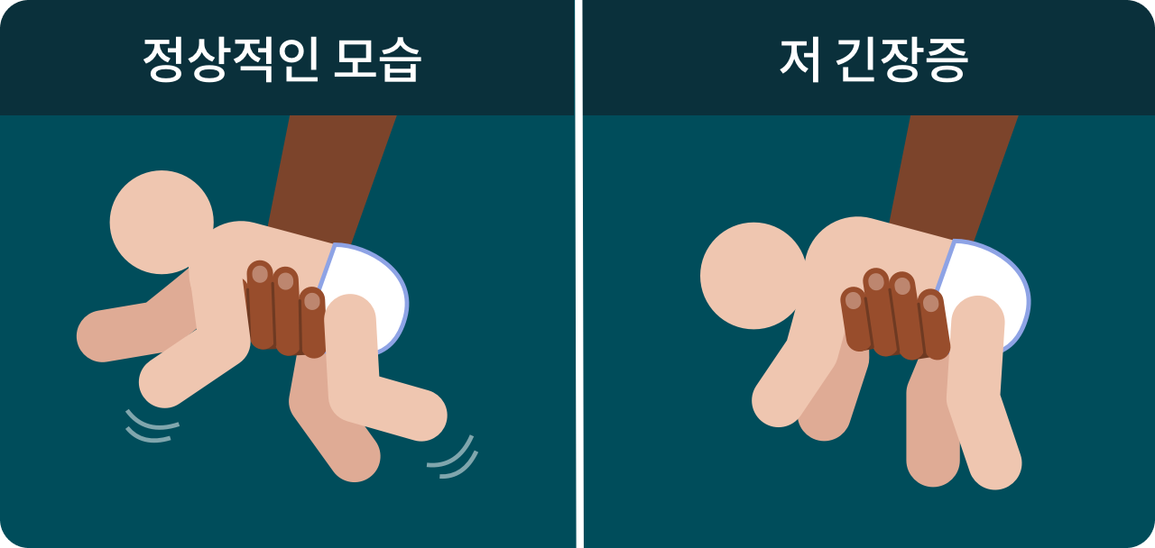 저 긴장증