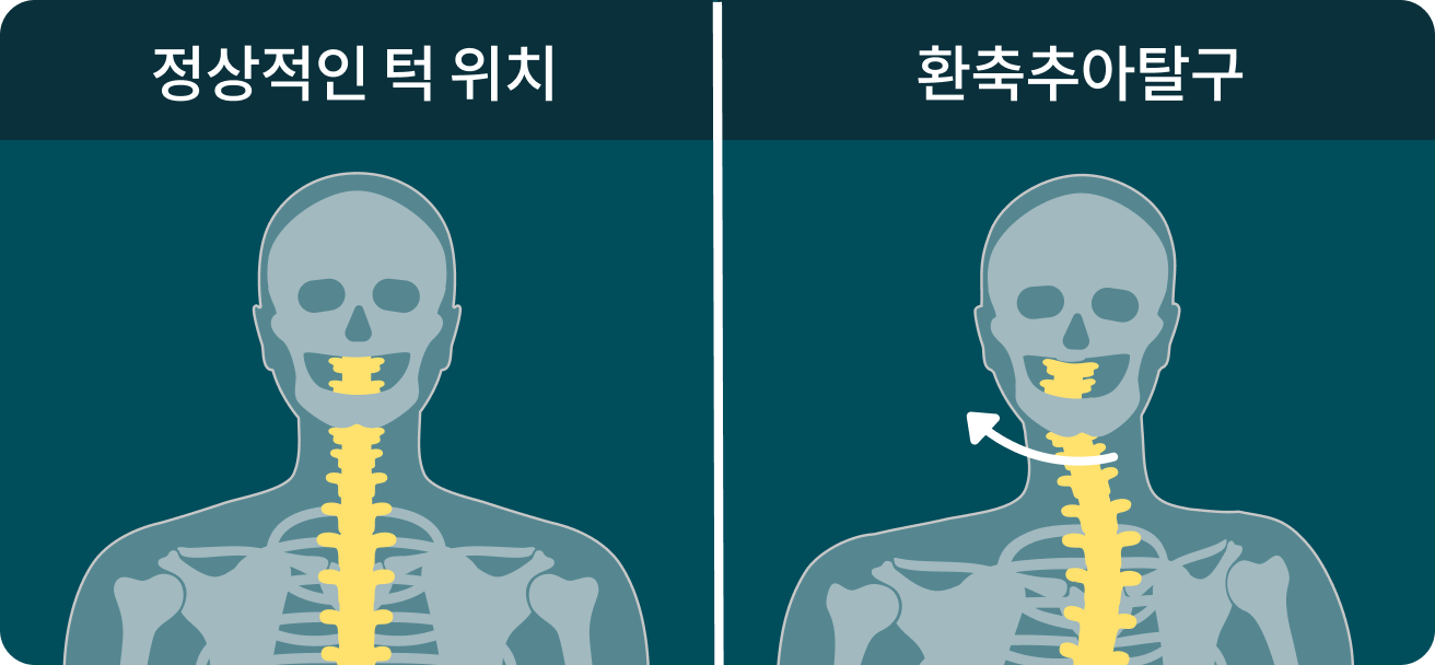 환축추아탈구