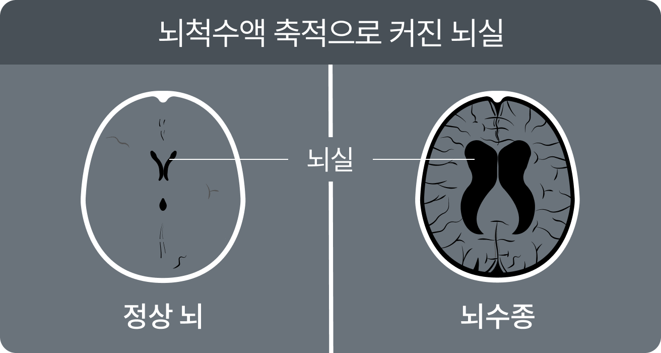 뇌척수액 축적으로 커진 뇌실