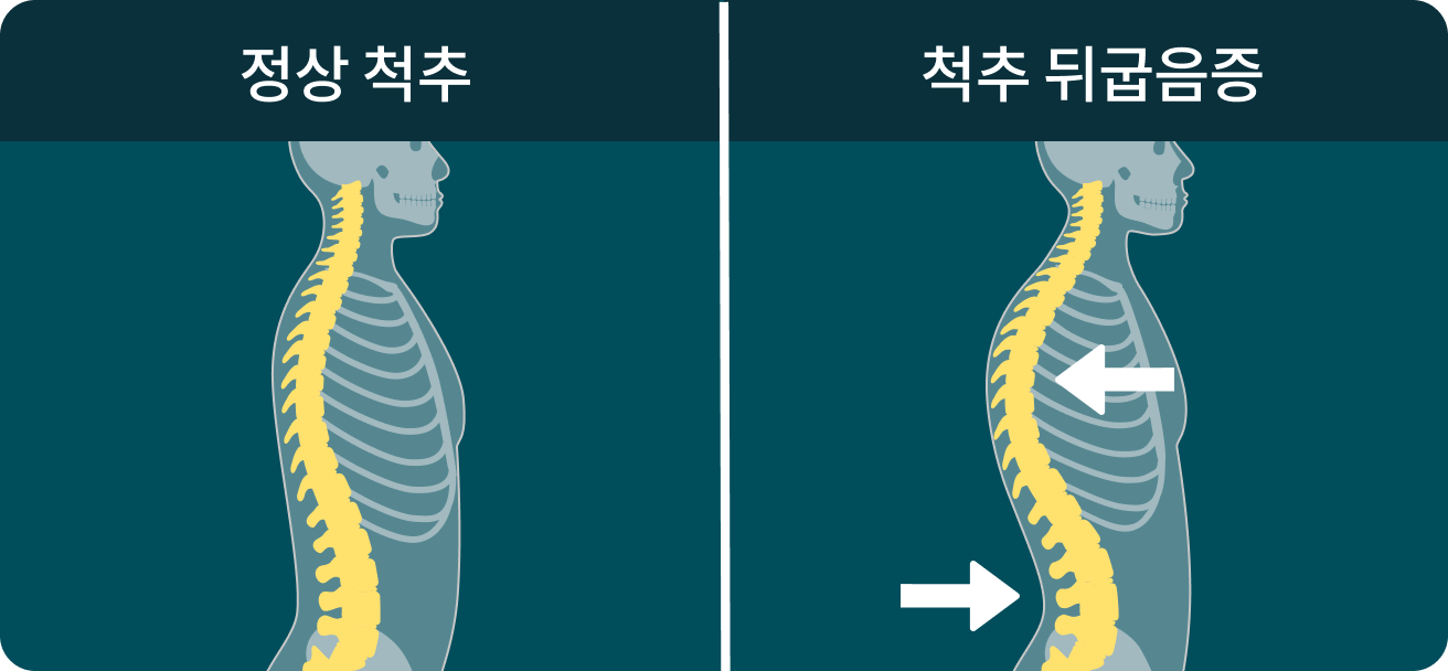 척추 뒤굽음증