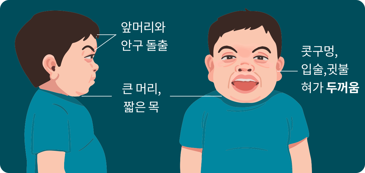 앞머리와 안구 돌출, 큰 머리, 짧은 목, 콧구멍, 입술, 귓불, 혀가 두꺼움