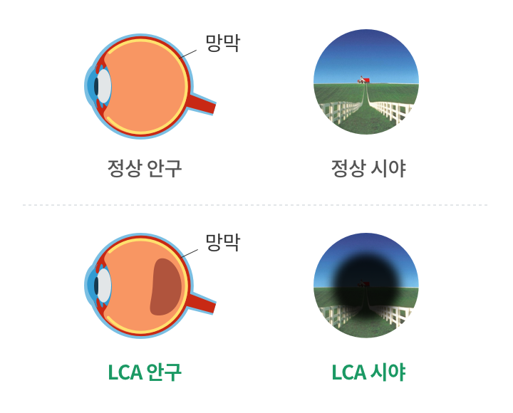 LCA 안구, LCA 시야