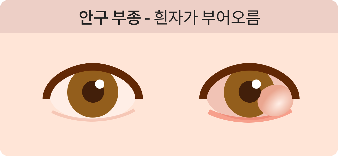 안구 부종, 흰자가 부어오름