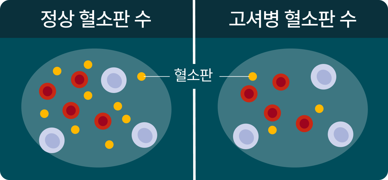 고셔병 혈소판 감소