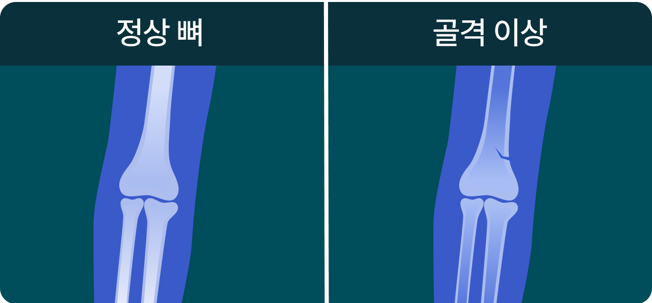 골격 이상