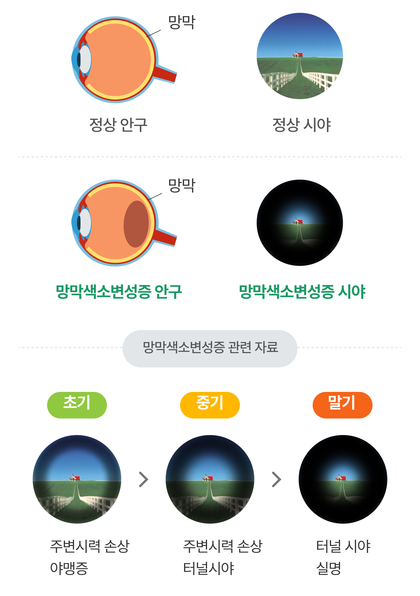 망막색소변성증 안구, 시야 등