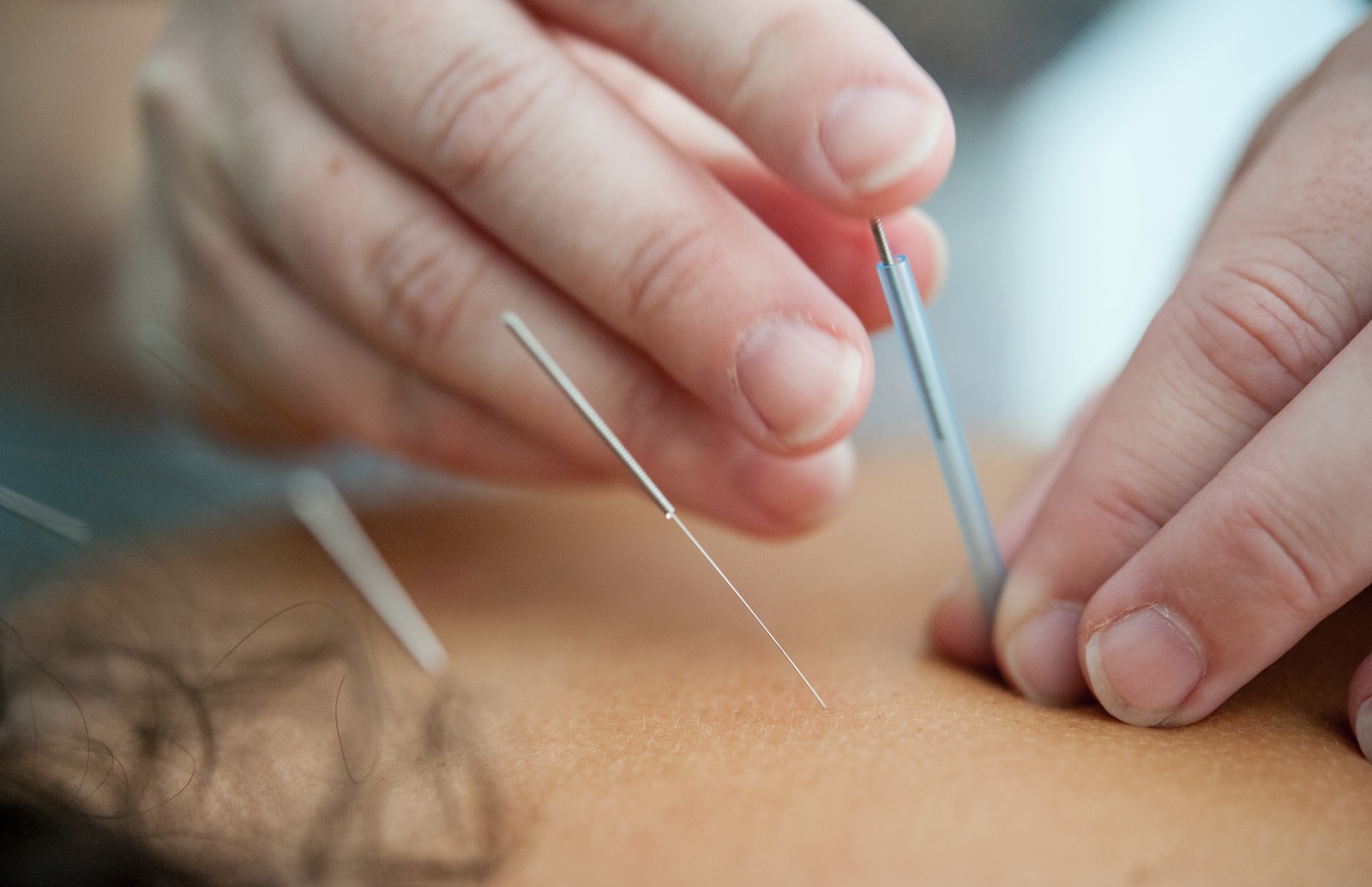 acupuntura pode ser usada no tratamento caseiro para parar de beber