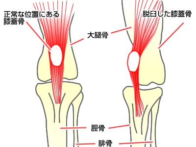 パテラの症状