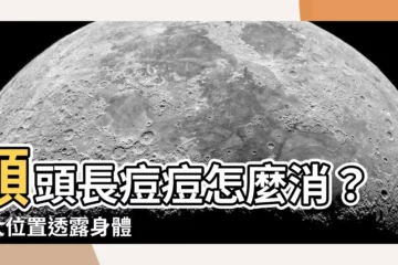 【額頭生瘡】額頭長痘痘怎麼消？ 5大位置透露身體秘密，預防方法大公開！