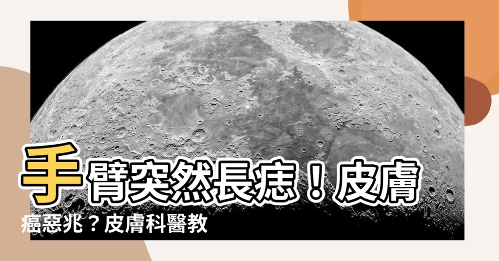 【手臂突然長痣】手臂突然長痣！皮膚癌惡兆？皮膚科醫教辨別5大警訊