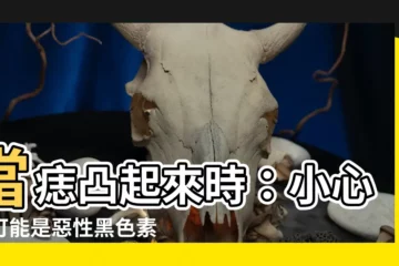 【痣突出來】當痣凸起來時：小心！可能是惡性黑色素瘤的徵兆