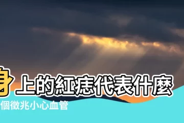 【身上有紅痣代表什麼】身上的紅痣代表什麼？3個徵兆小心血管瘤！