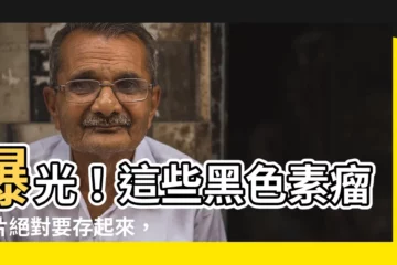 【黑色素瘤照片】曝光！這些黑色素瘤照片絕對要存起來，助你一眼分辨皮膚癌