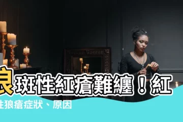 【狼班性紅瘡】狼斑性紅瘡難纏！紅斑性狼瘡症狀、原因及治療一次看