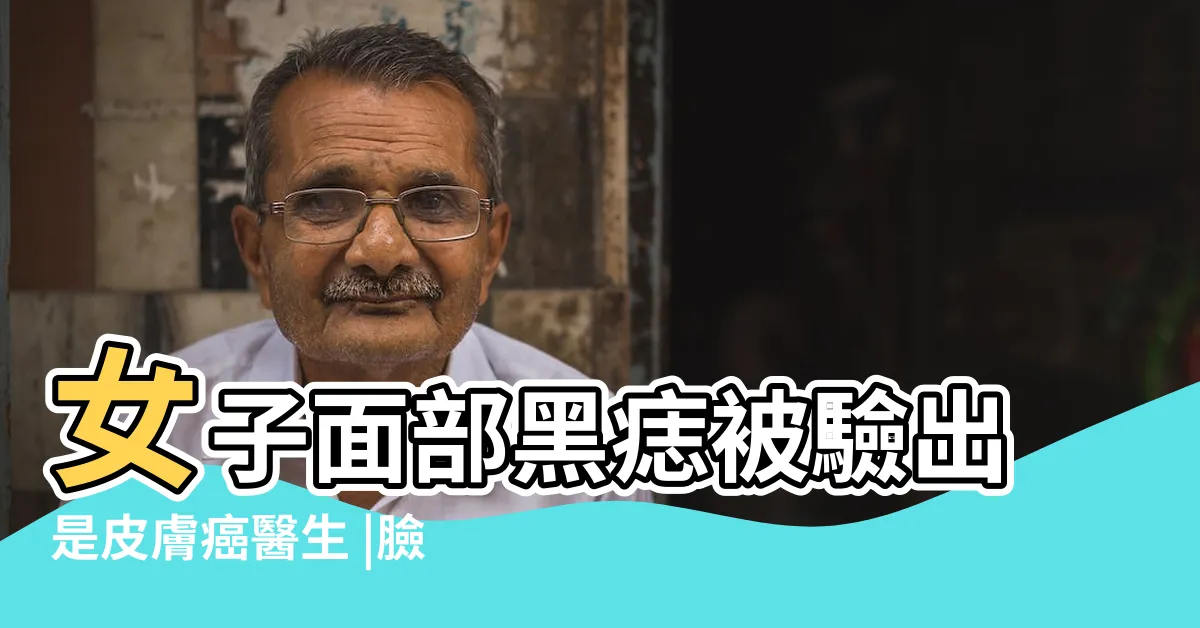 【面部黑痣】女子面部黑痣被驗出是皮膚癌醫生 |臉上的黑痣可以隨便去掉嗎 |有5種痣最危險 |